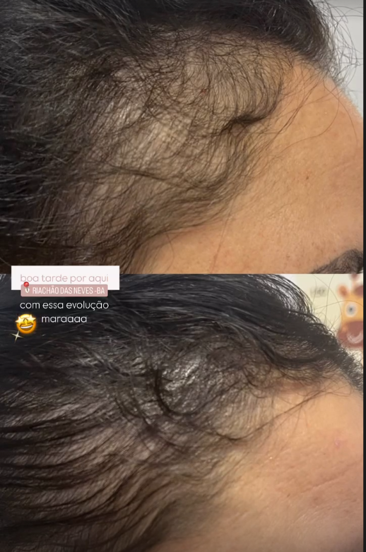 Resultado de tratamento estético 4